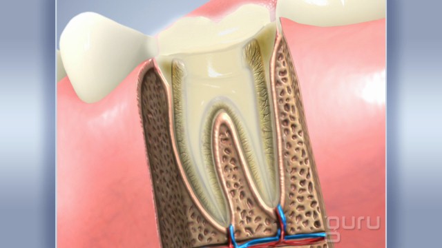 Root Canal Posterior